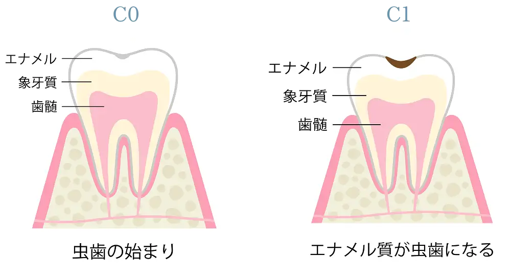 虫歯の進行段階の画像