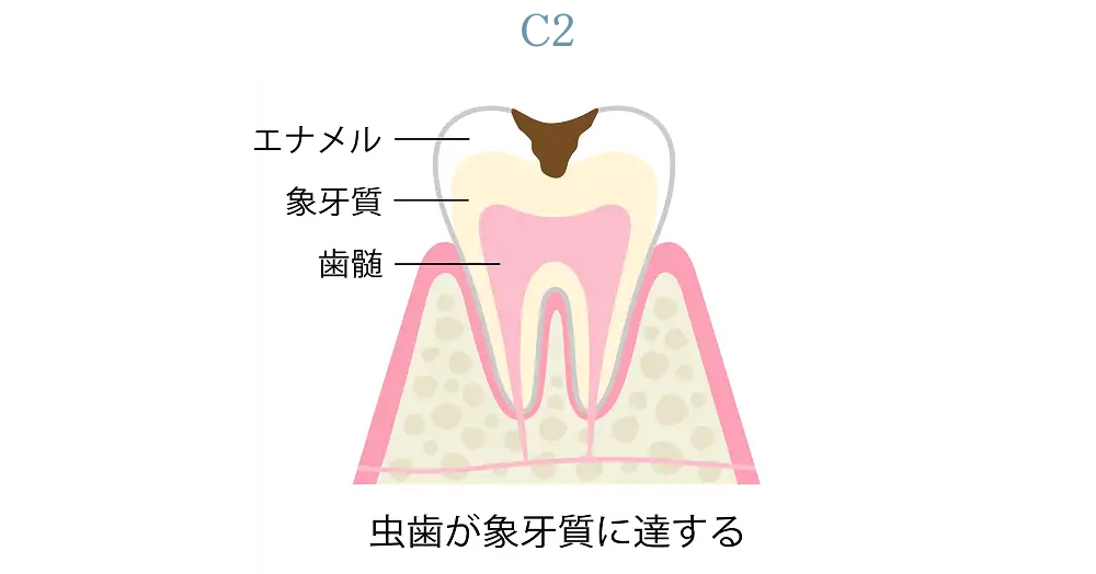虫歯の進行段階の画像