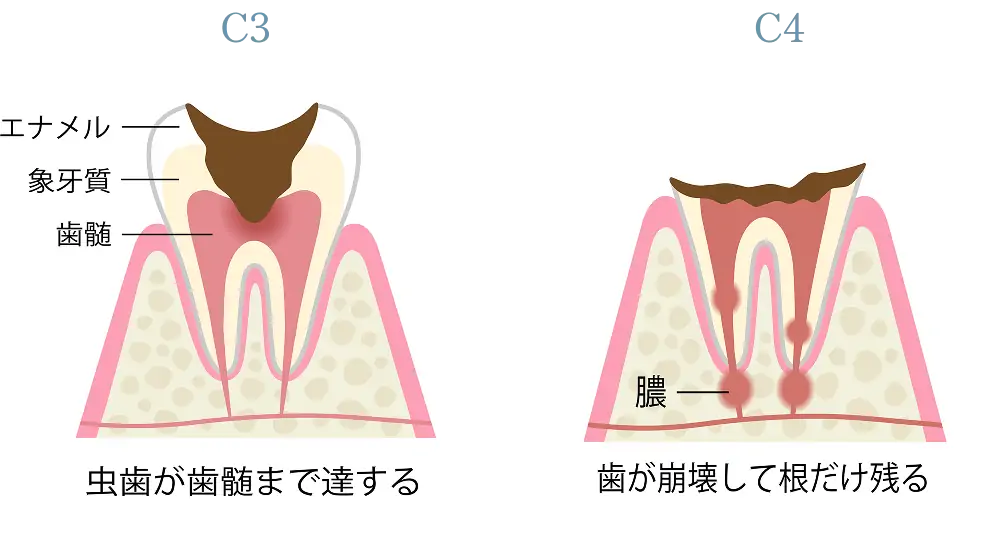 虫歯の進行段階の画像